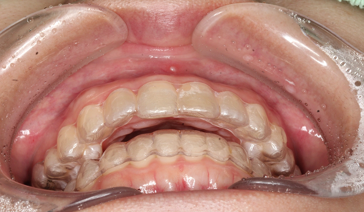 術後:前歯部あおり