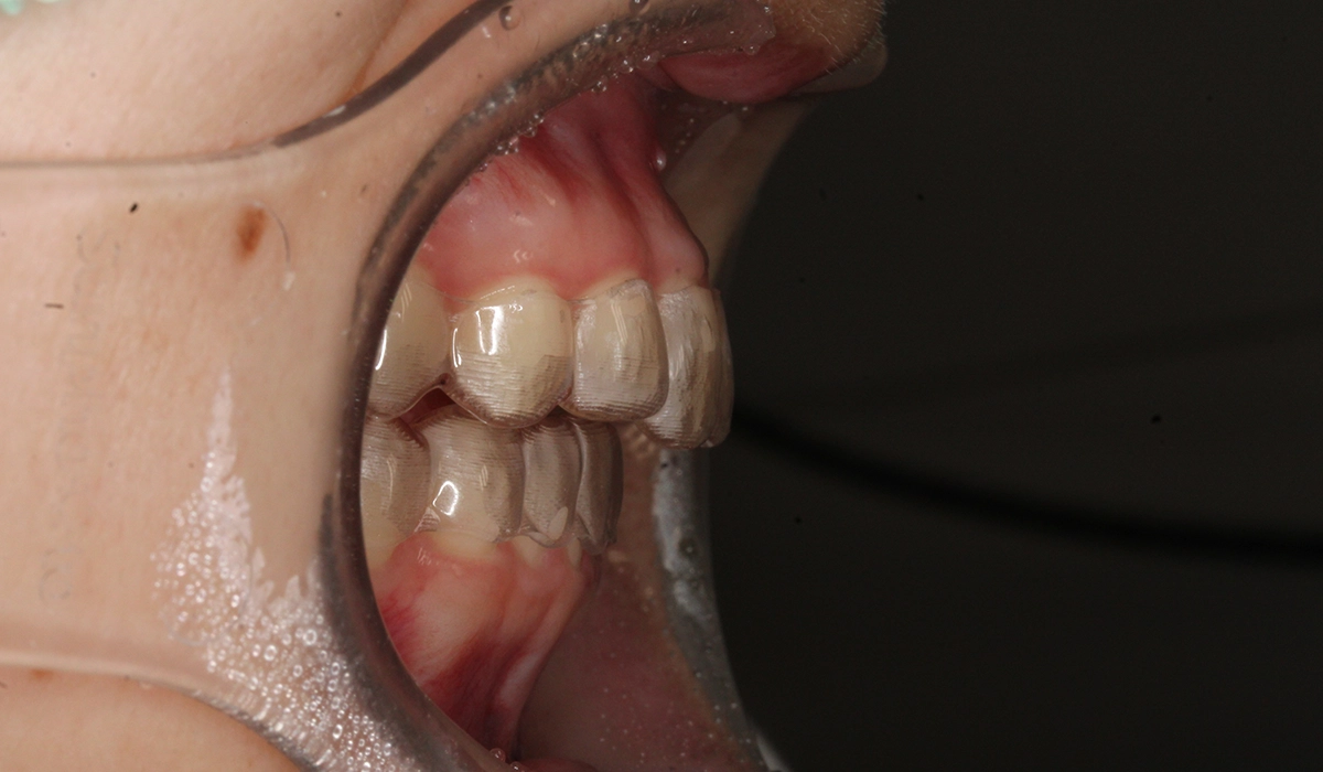 術後:オーバージェット