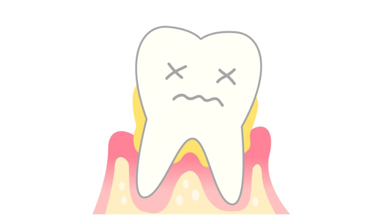 1．重度の歯周病