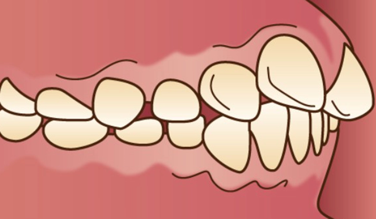 2．重度の出っ歯
