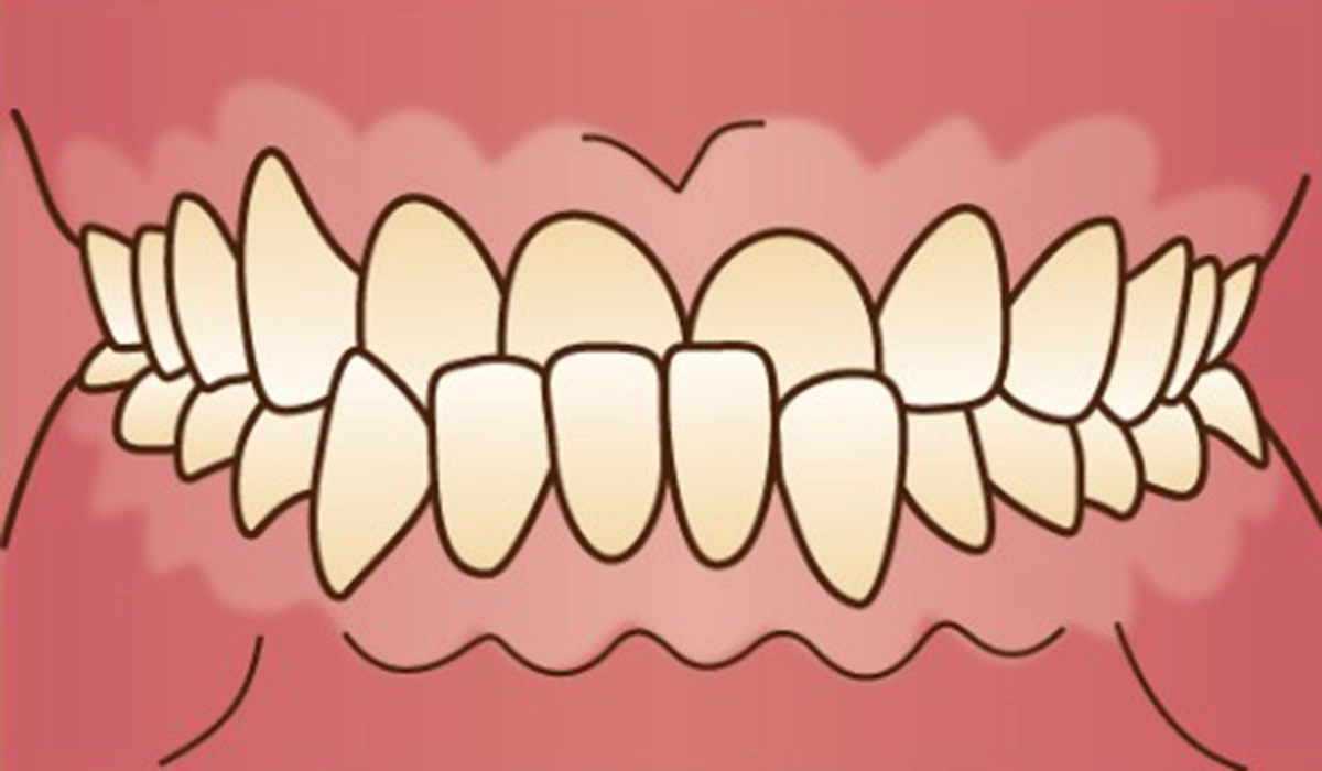 3．重度の受け口