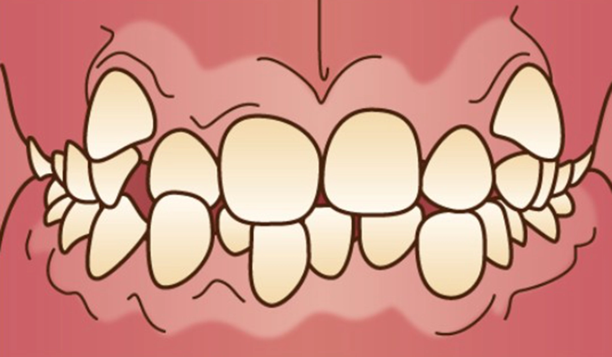 4．歯並びが重度に乱れている