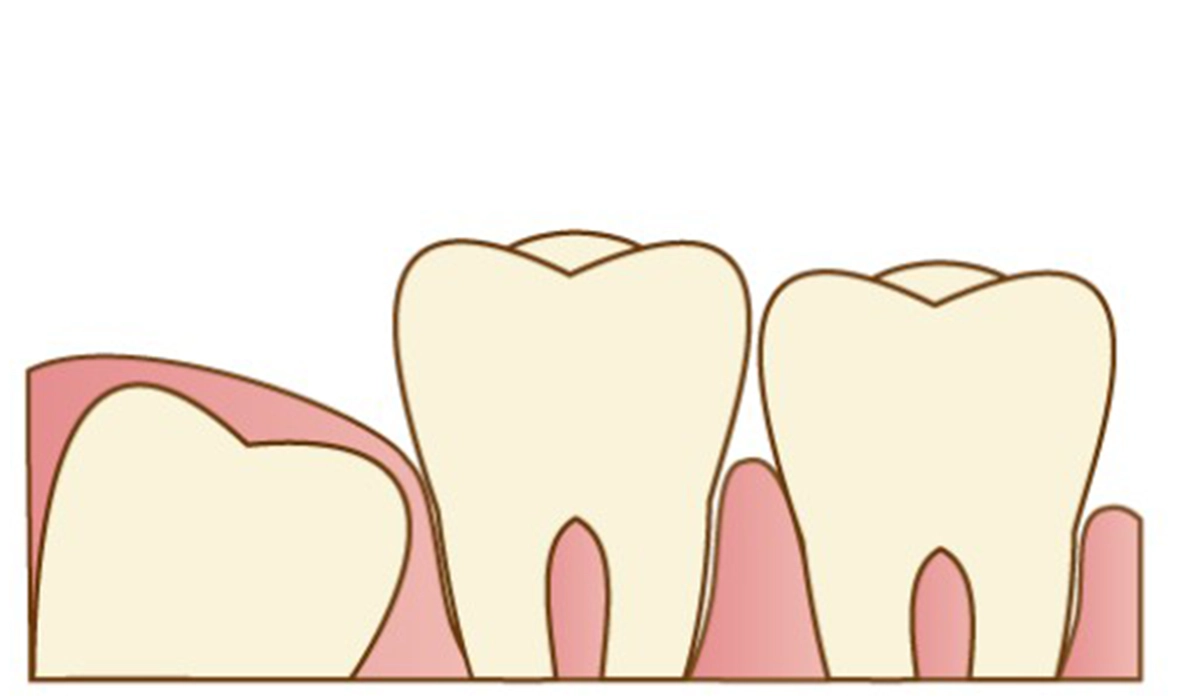 5．埋伏歯がある