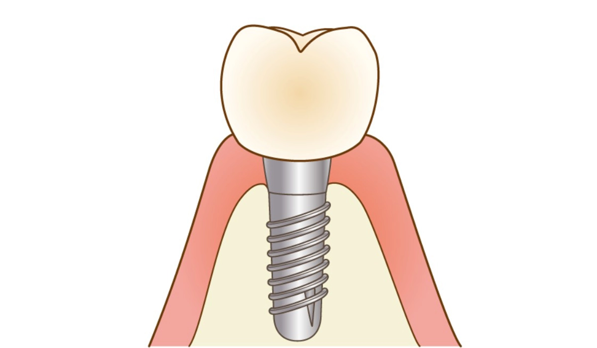 6．インプラントが入っている