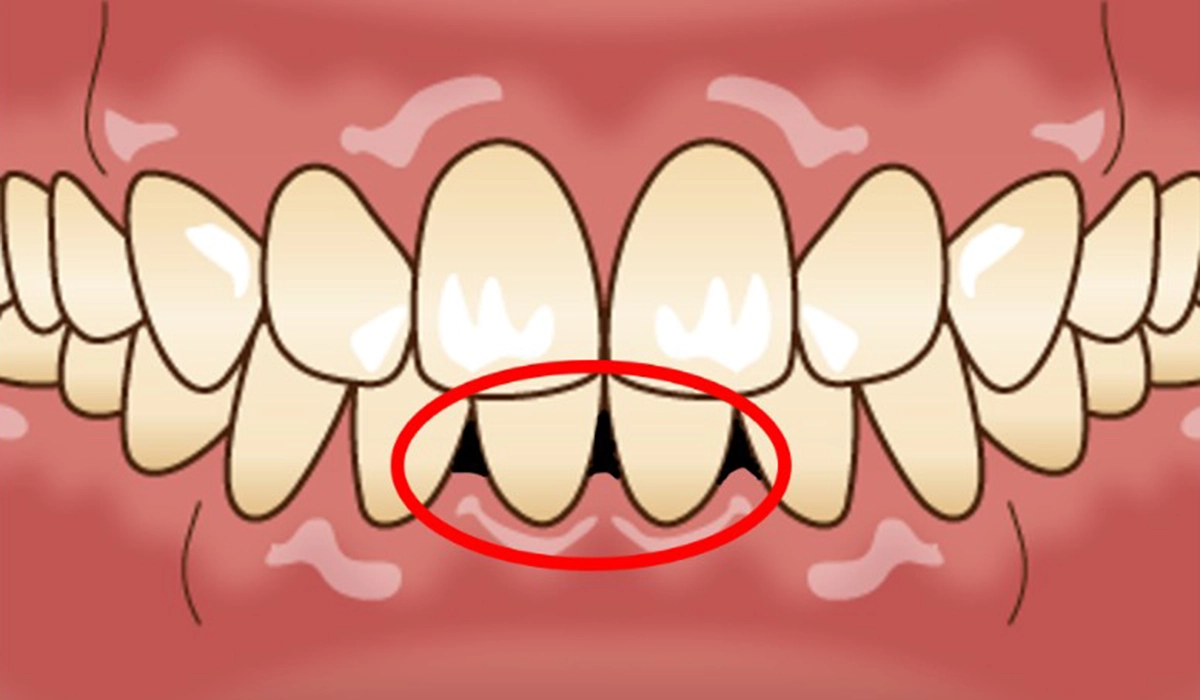 ブラックトライアングルとは