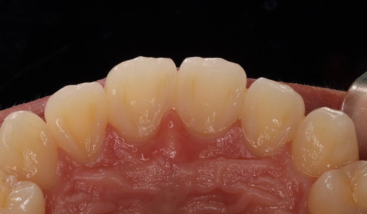 術前:上顎前歯部寄り