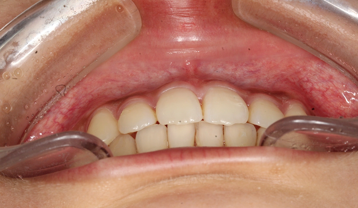 術後:前歯部あおり