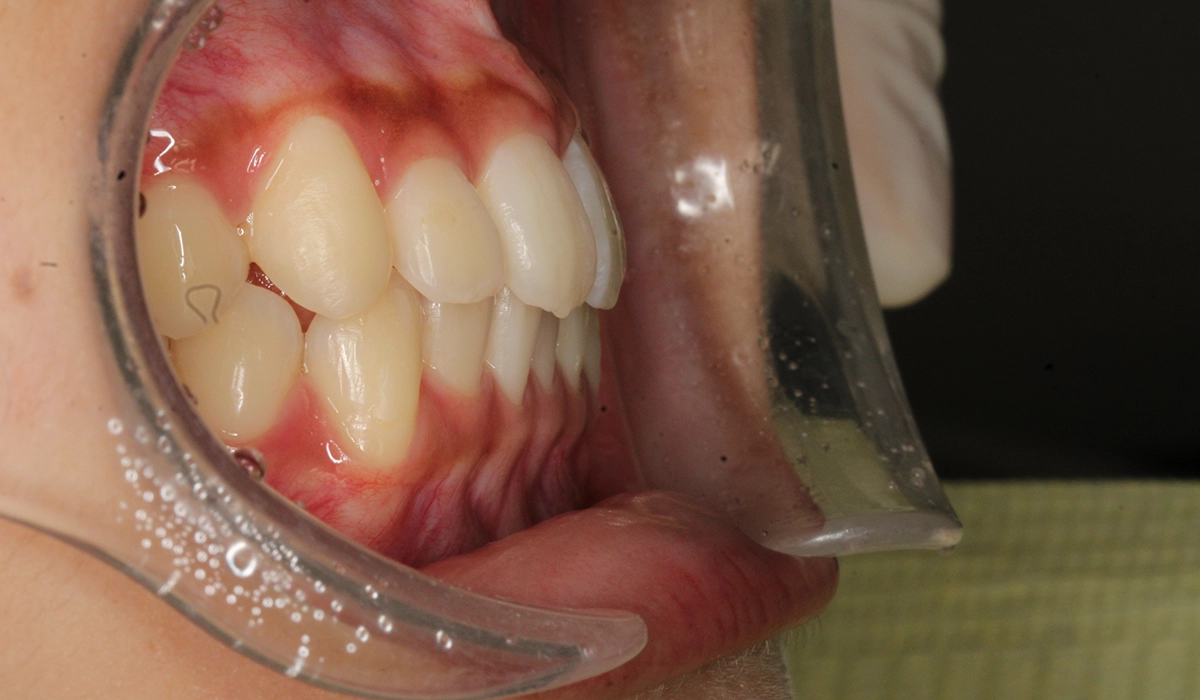 術後:オーバージェット