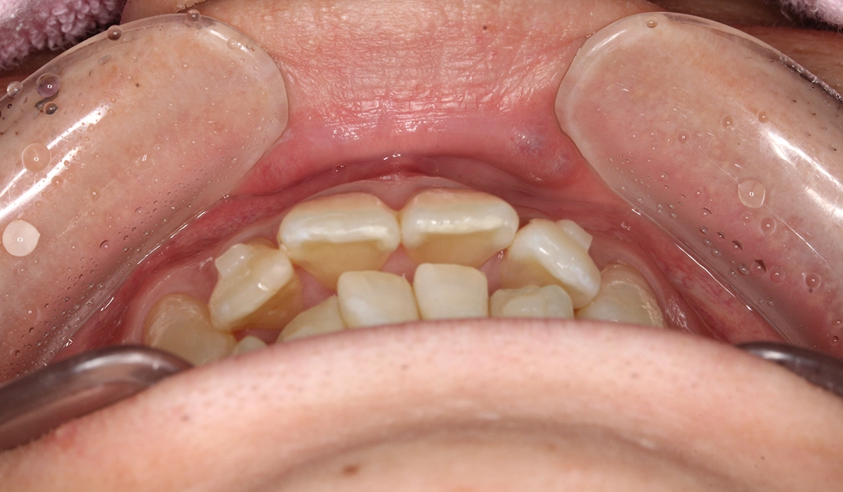 術前:前歯部あおり