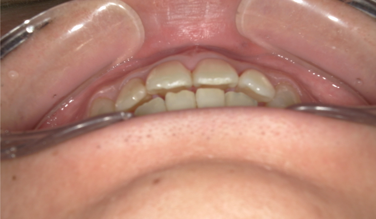 術後:前歯部あおり