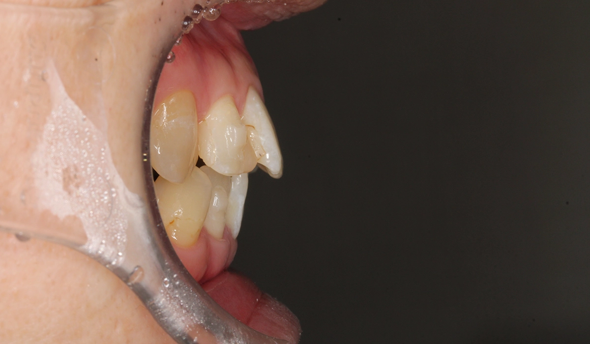 術前:オーバージェット