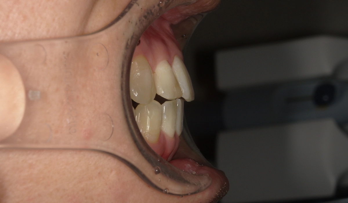 術後:オーバージェット