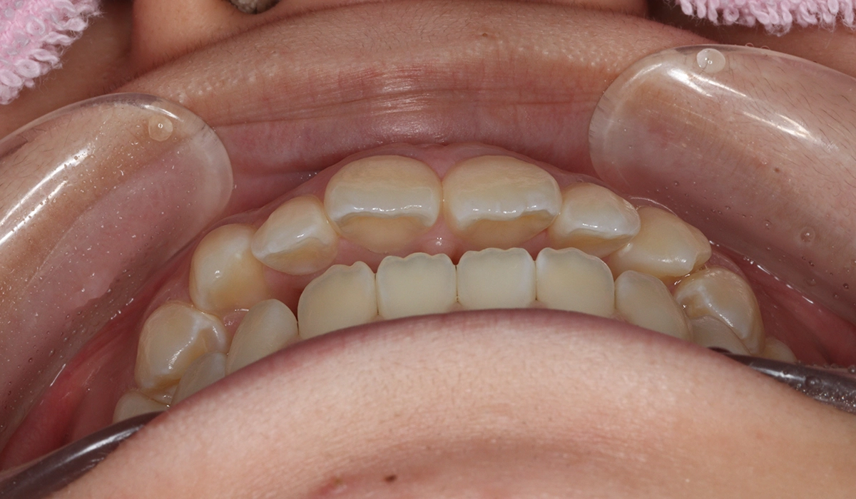 術前:前歯部あおり