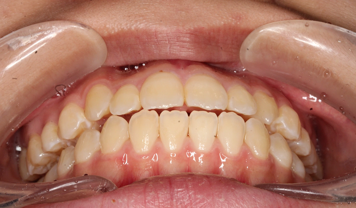 術後:前歯部あおり