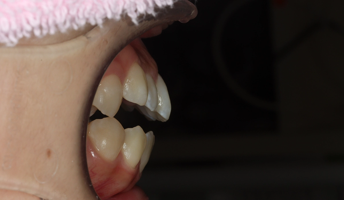 術前:オーバージェット