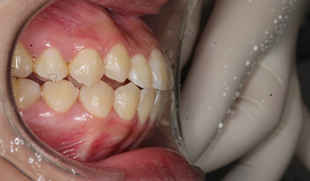 術後:オーバージェット