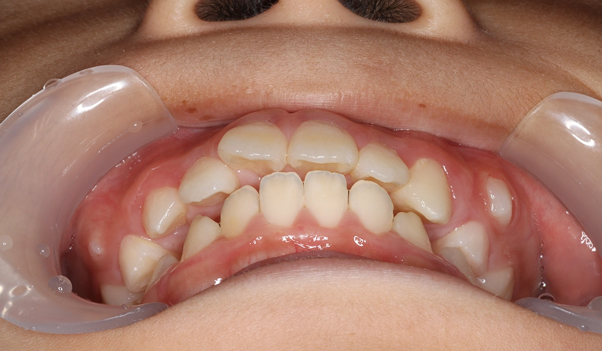 術前:前歯部あおり