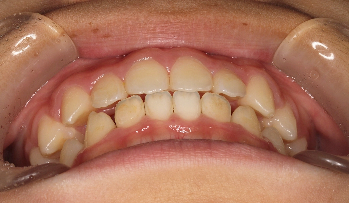 術後:前歯部あおり