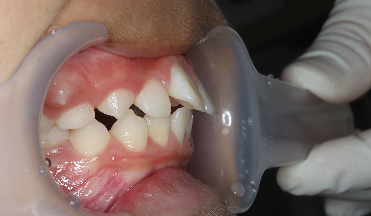 術前:オーバージェット