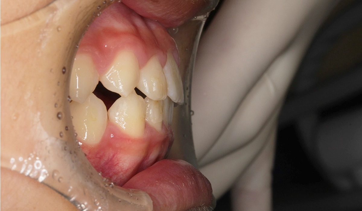 術後:オーバージェット