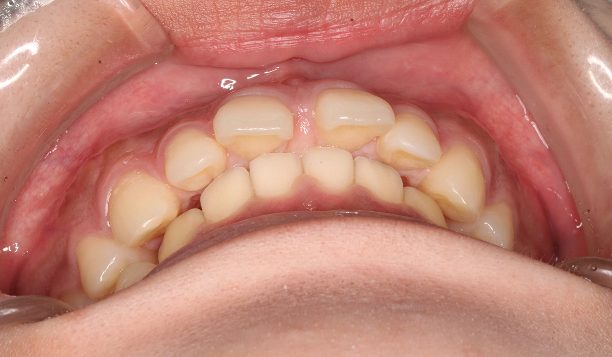 術前:前歯部あおり