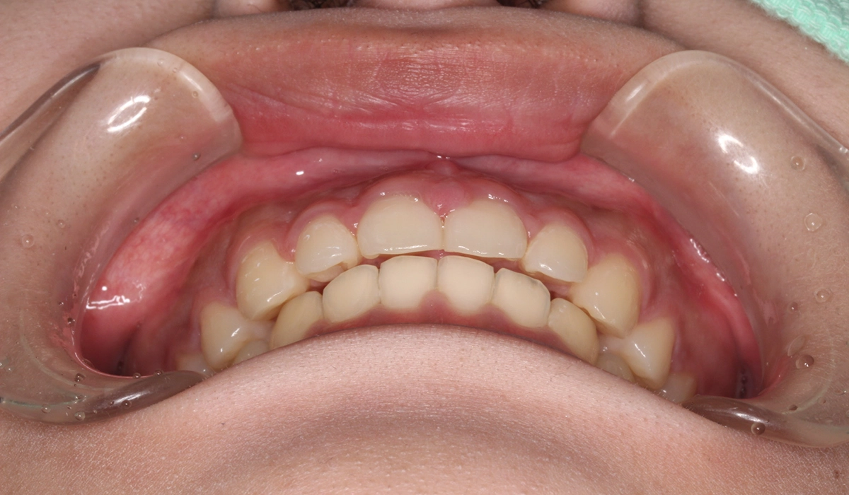 術後:前歯部あおり