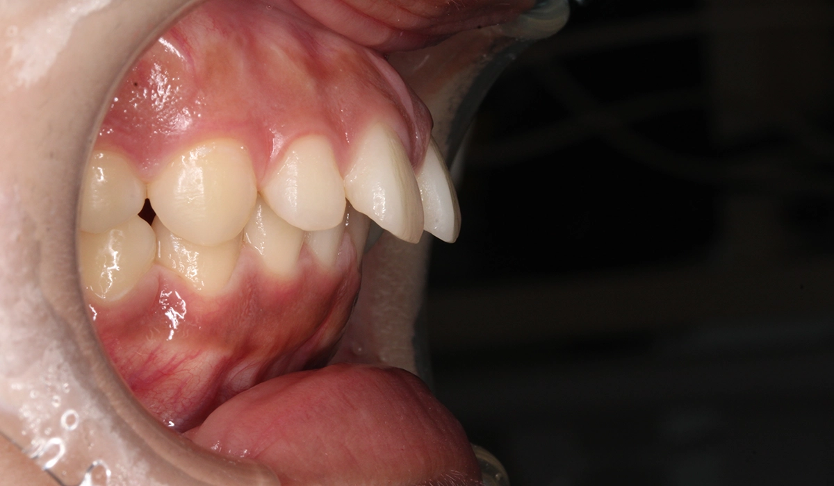 術前:オーバージェット