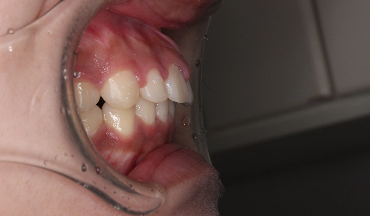 術後:オーバージェット