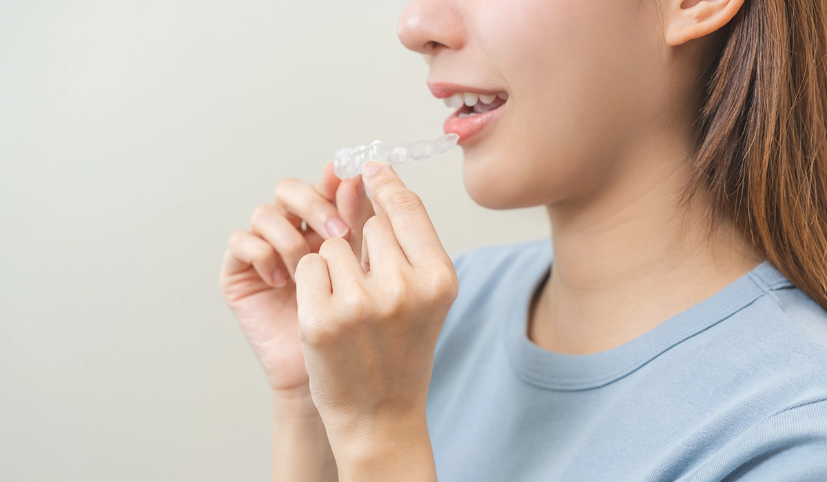 リテーナーは、インビザライン終了後の歯の後戻りを防ぐ重要なもの