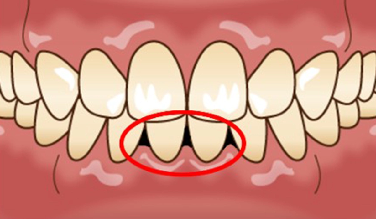 ブラックトライアングル