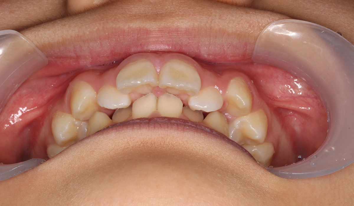 術前:前歯部あおり