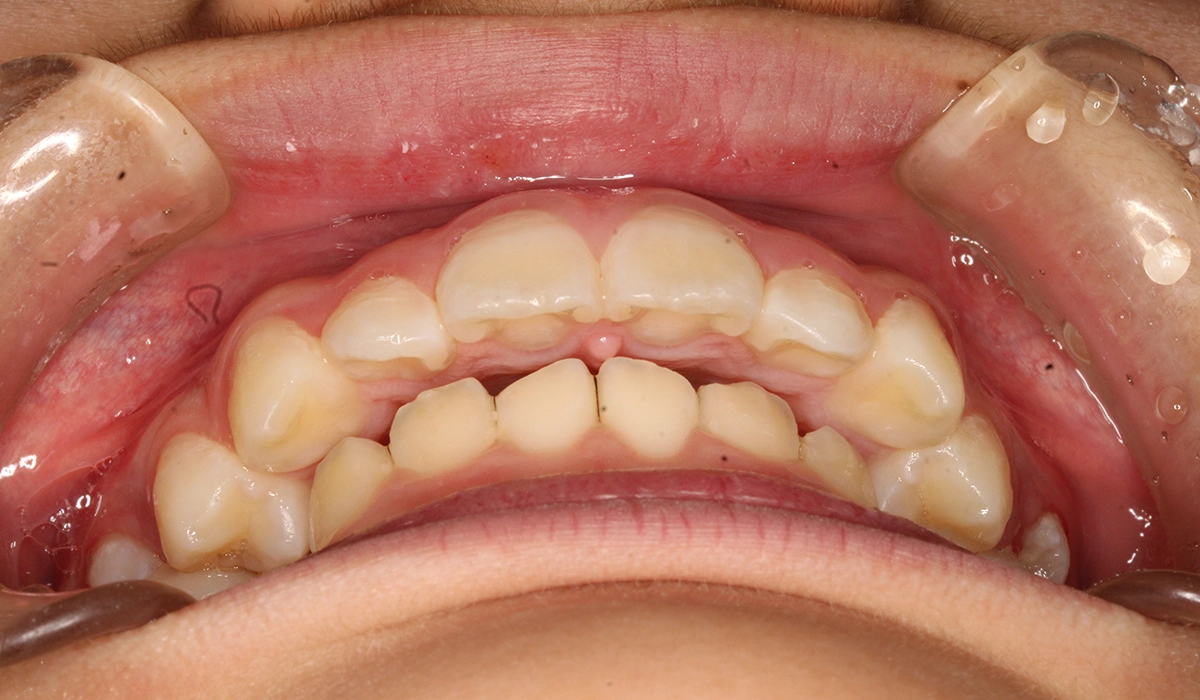 術後:前歯部あおり