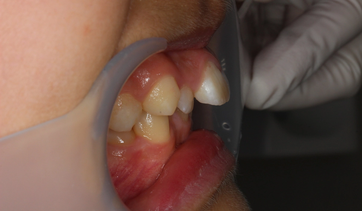 術前:オーバージェット