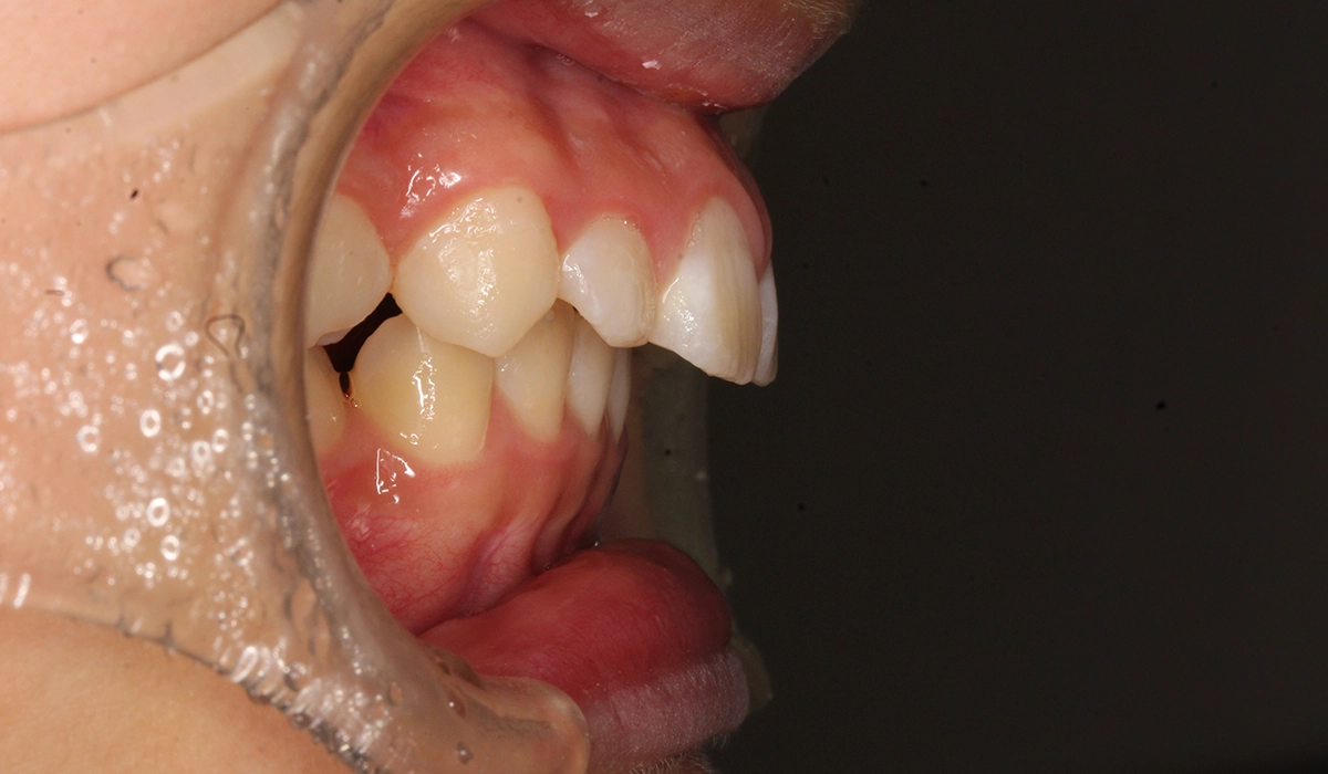 術後:オーバージェット