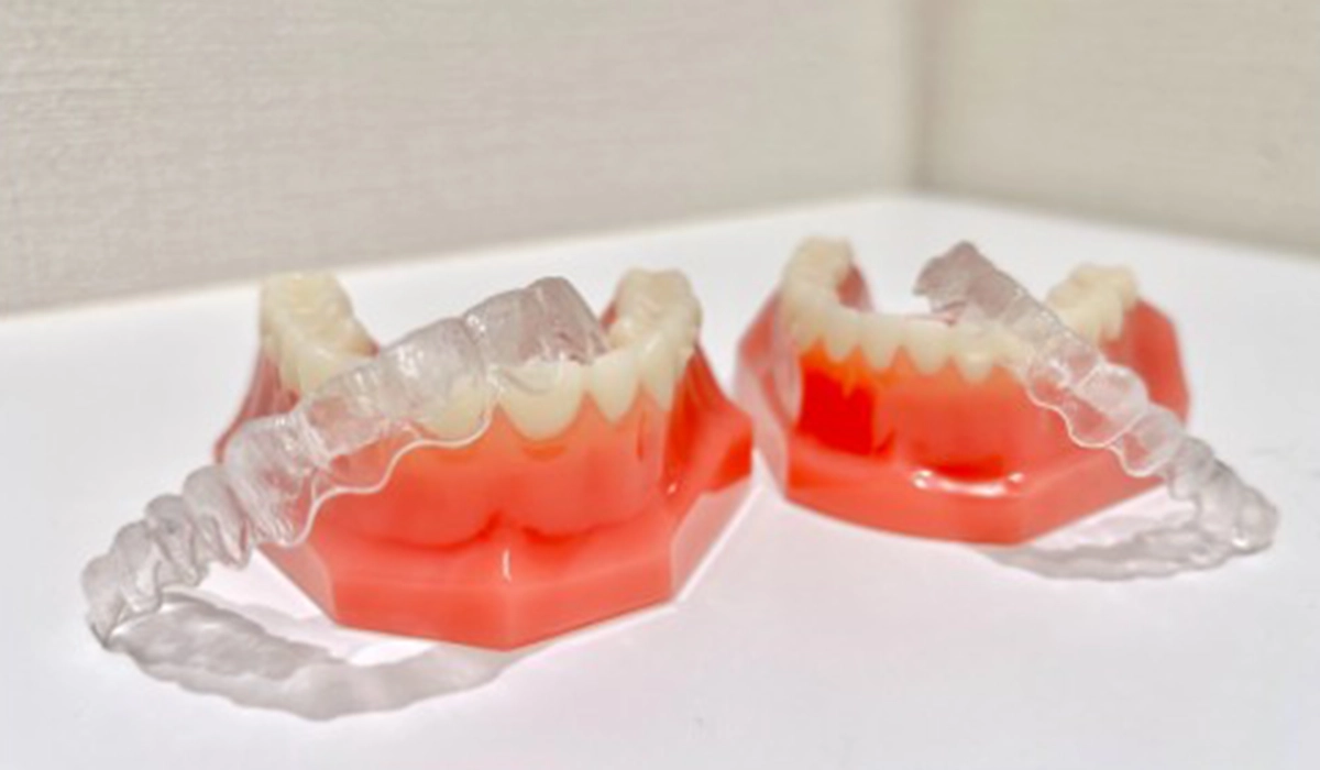 インビザラインで前歯のみの矯正ができないケース