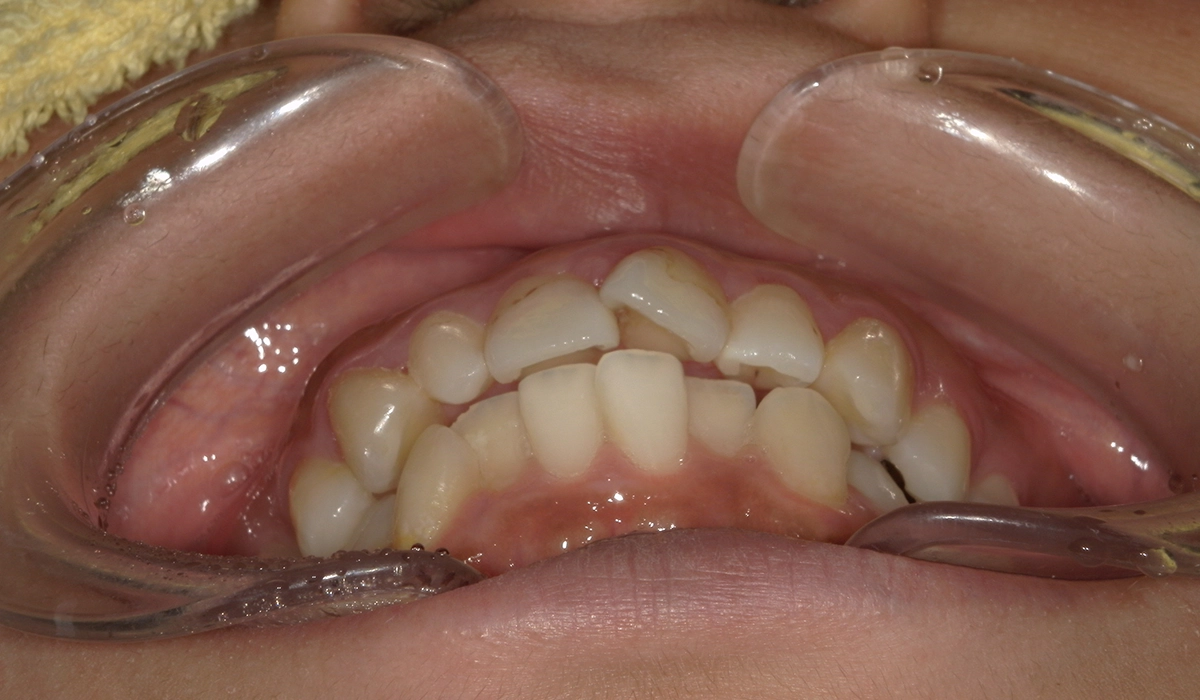 術前:前歯部あおり