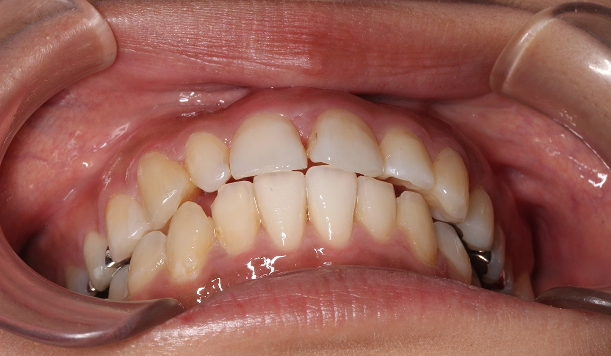 術後:前歯部あおり