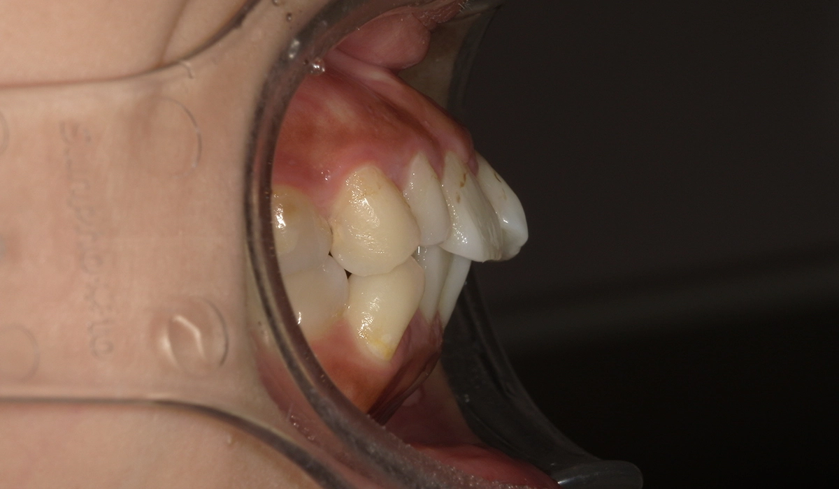 術前:オーバージェット