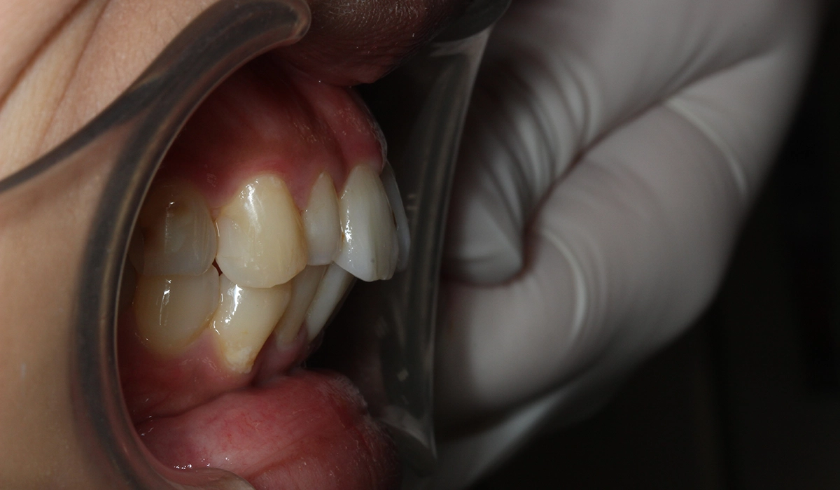 術後:オーバージェット