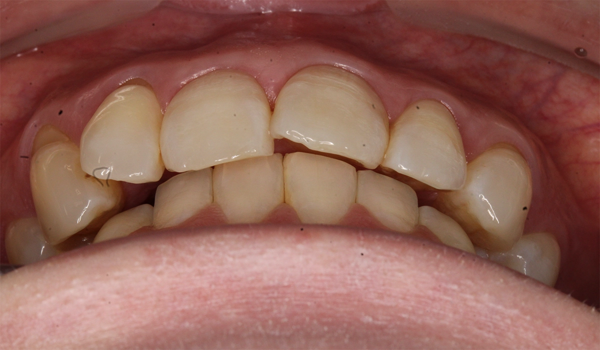 術前:前歯部あおり