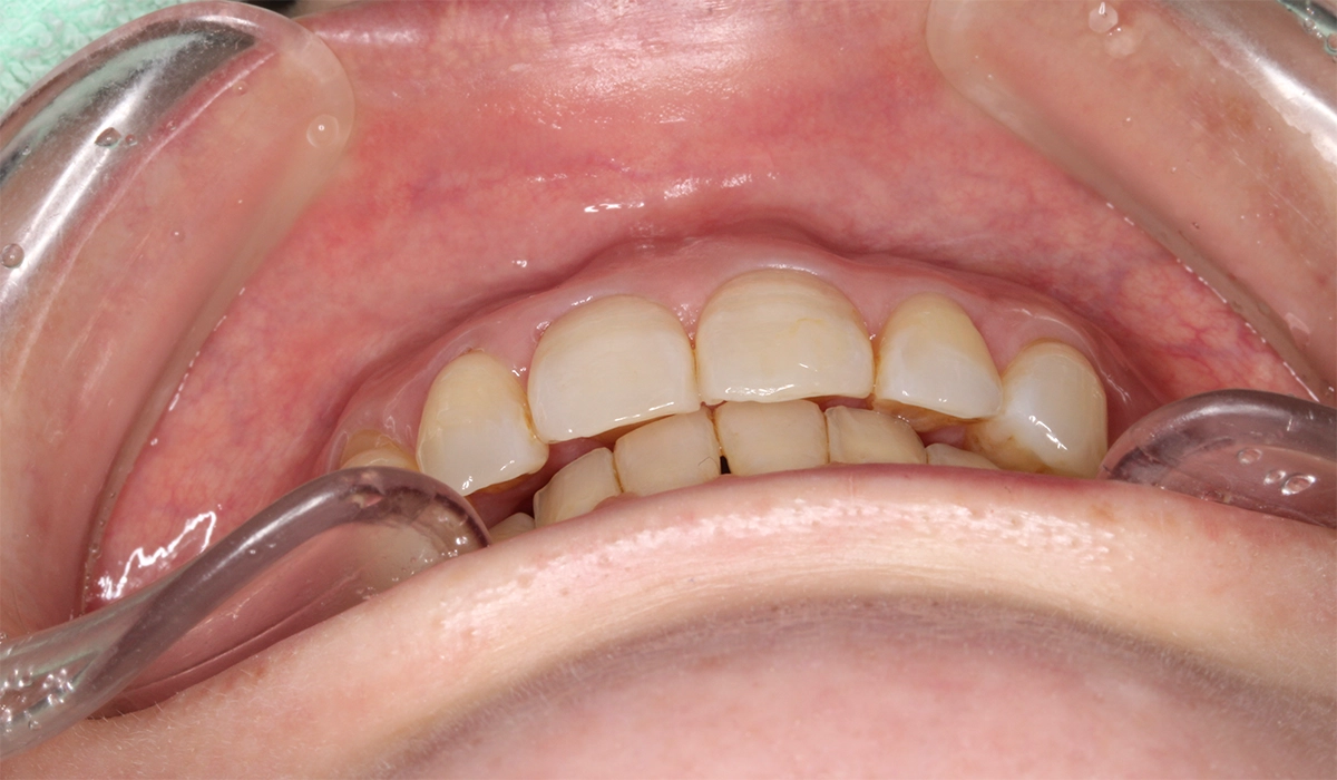 術後:前歯部あおり