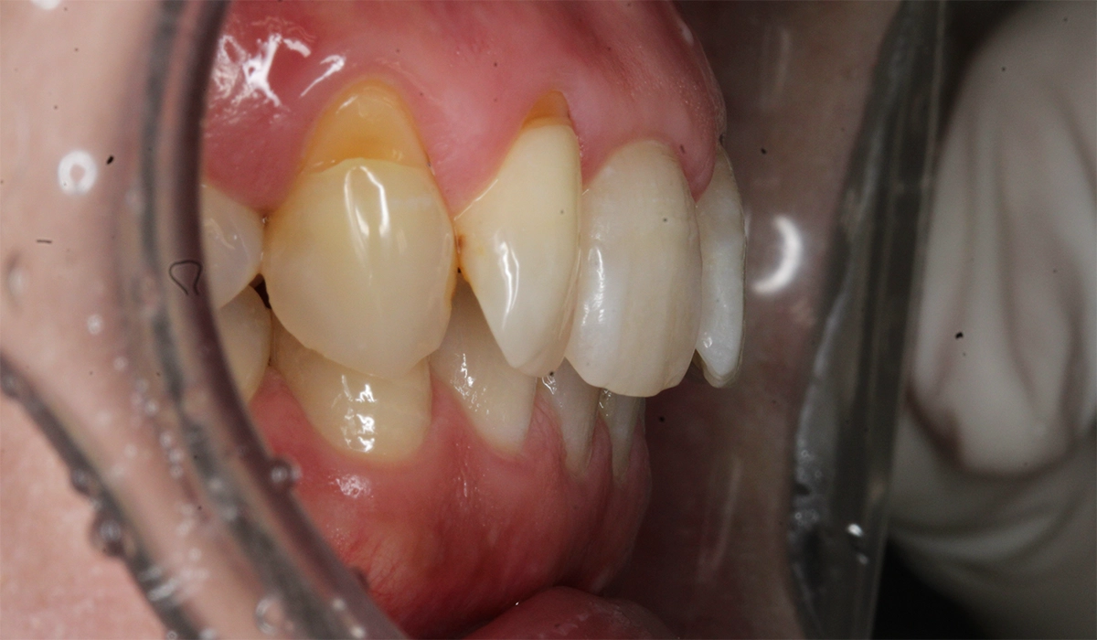 術前:オーバージェット