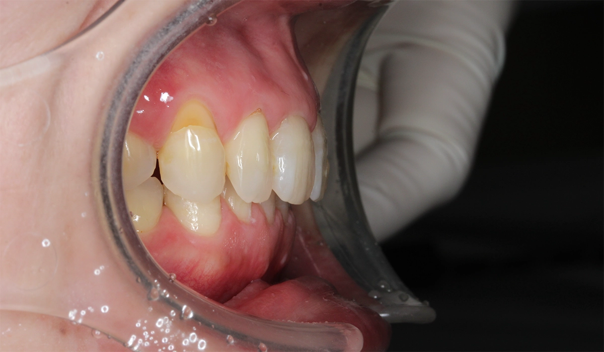 術後:オーバージェット