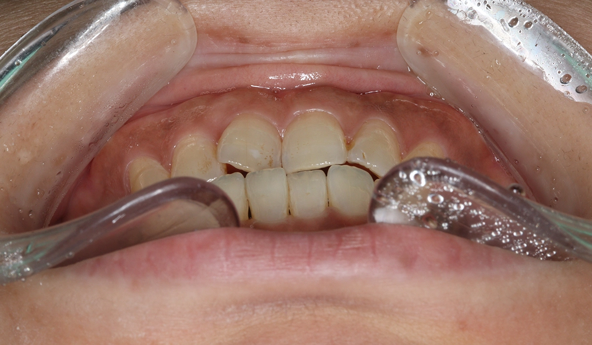 術前:前歯部あおり