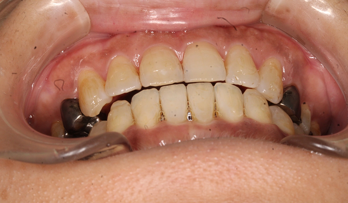 術後:前歯部あおり