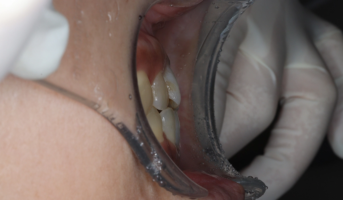 術前:オーバージェット