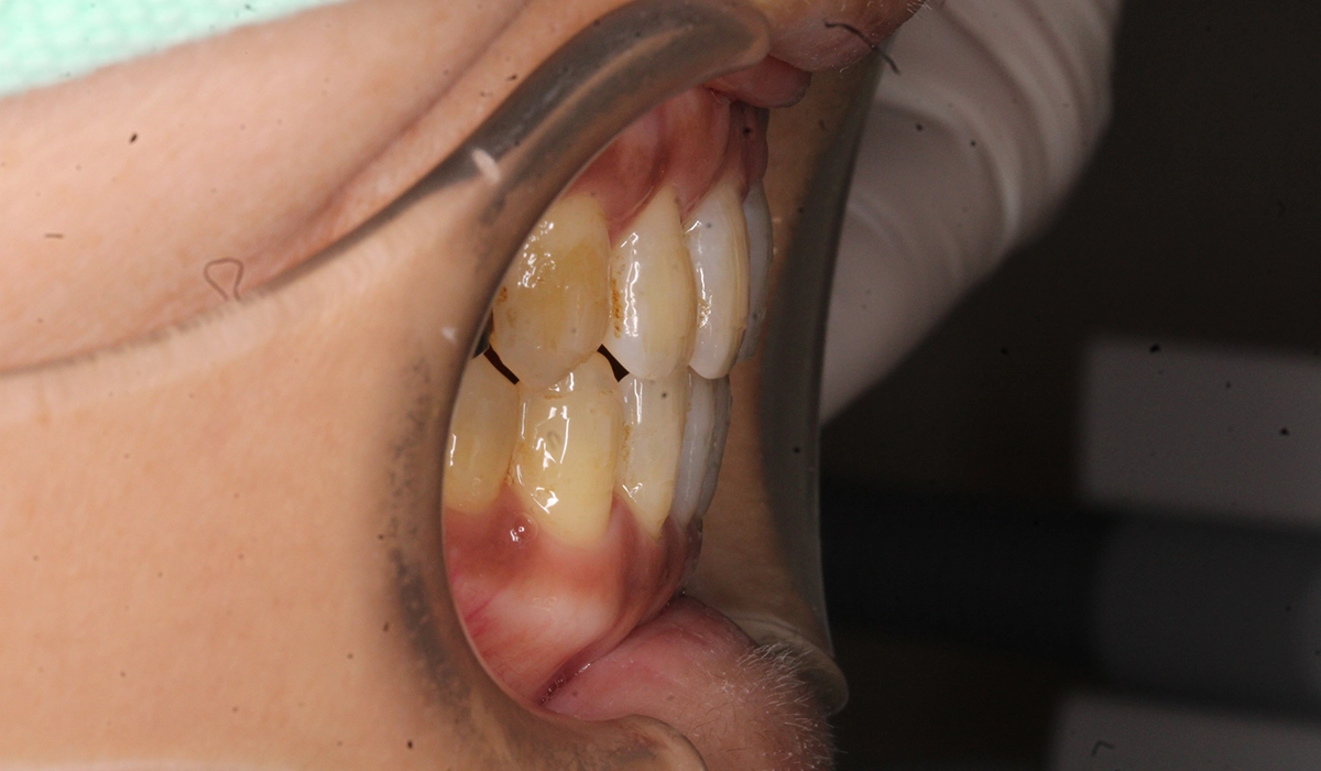 術後:オーバージェット