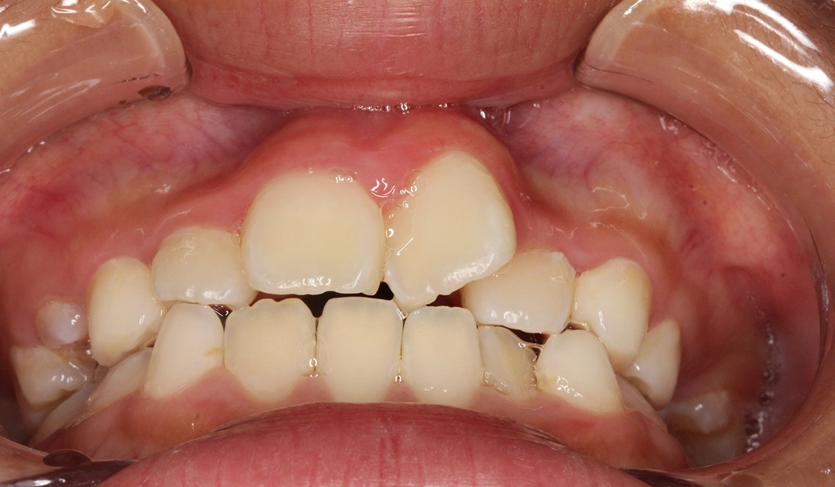 術前:前歯部あおり