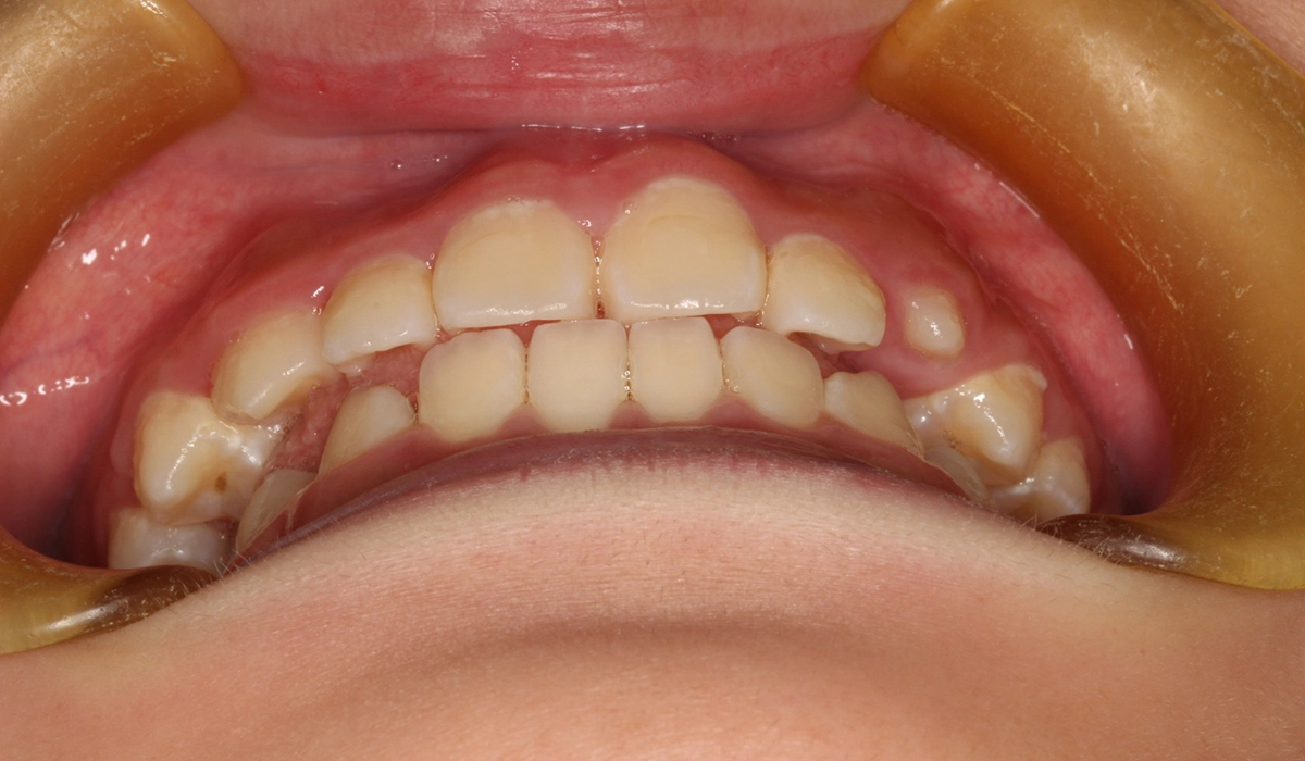 術後:前歯部あおり