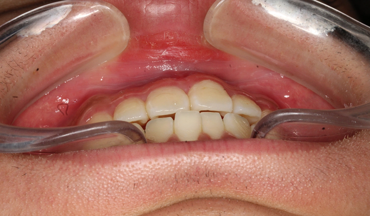 術後:前歯部あおり